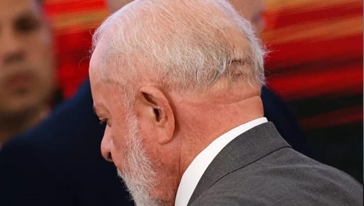 Lula está “estável” e passa bem após cirurgia, diz novo boletim médico