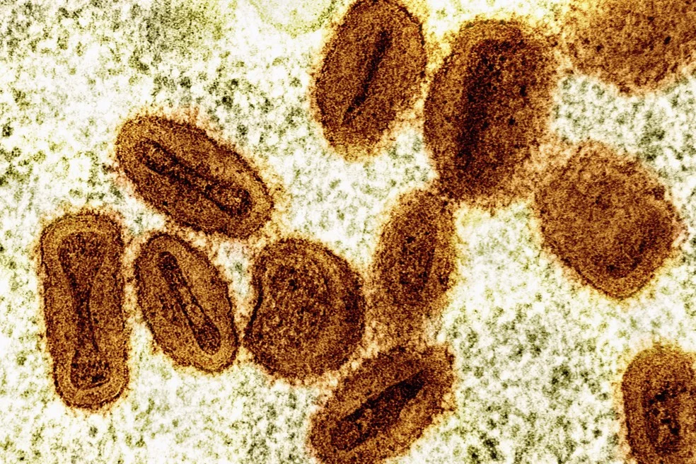 Ministério da Saúde confirma primeiro caso da nova cepa do vírus Mpox