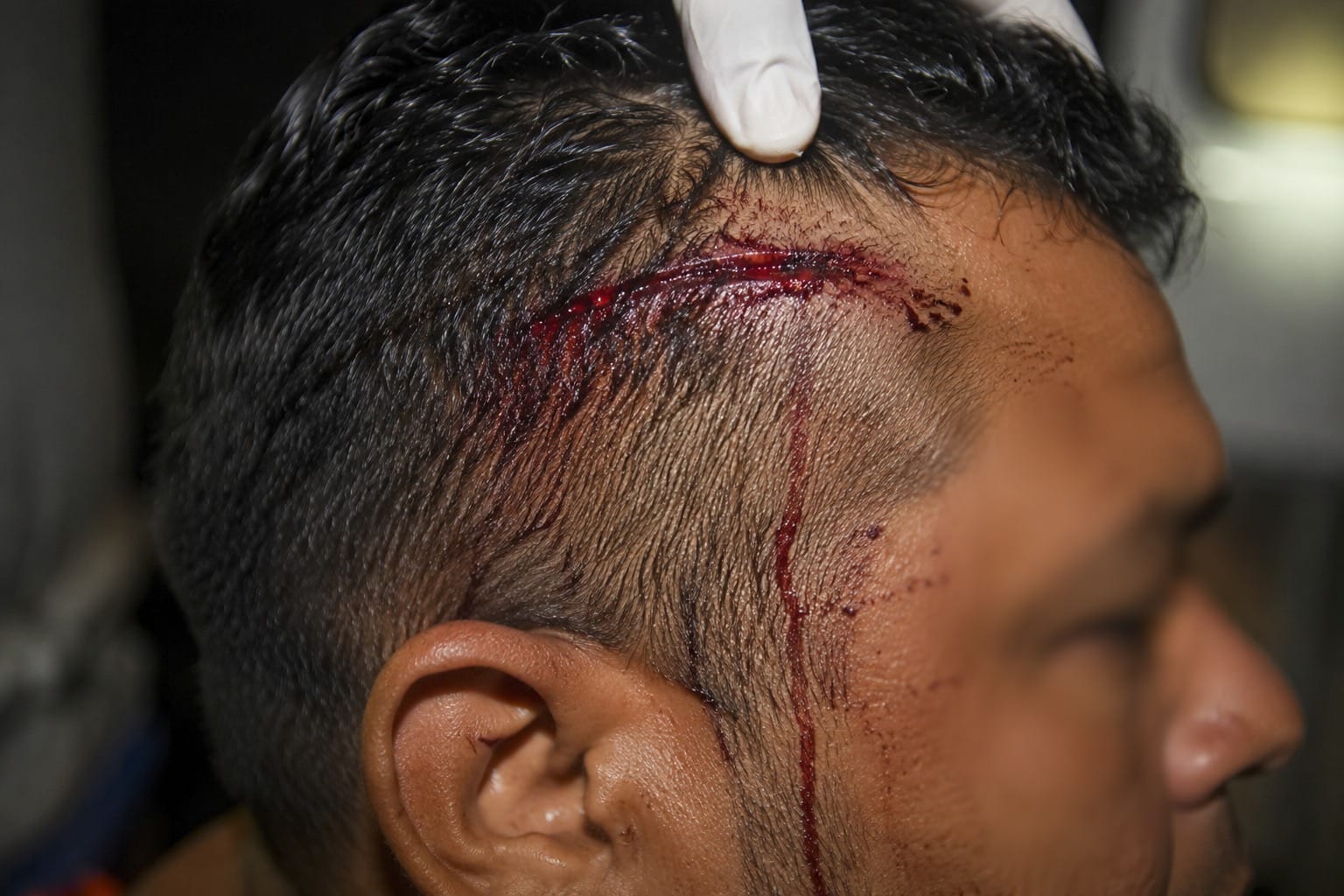 Homem escapa de seqüestradores após ser torturado e atingido por tiro de raspão na cabeça